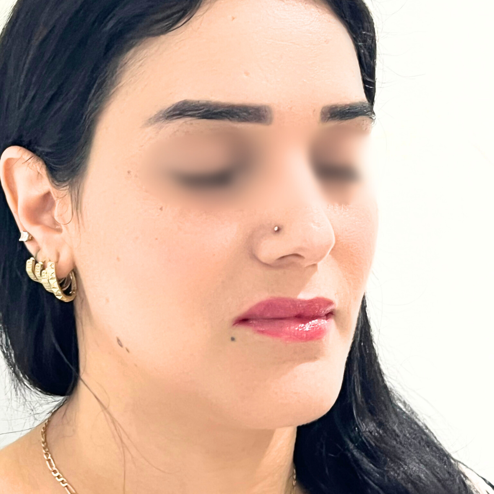 hc aesthetics-cabinet-lipofiling hc aesthetics-cabinet-lipofiling