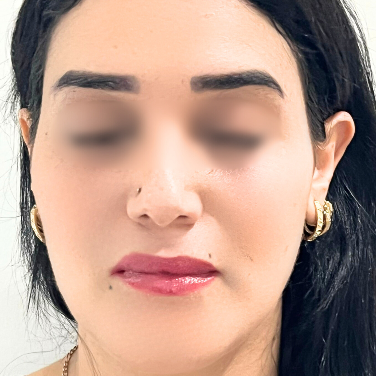 hc aesthetics-cabinet-lipofiling hc aesthetics-cabinet-lipofiling