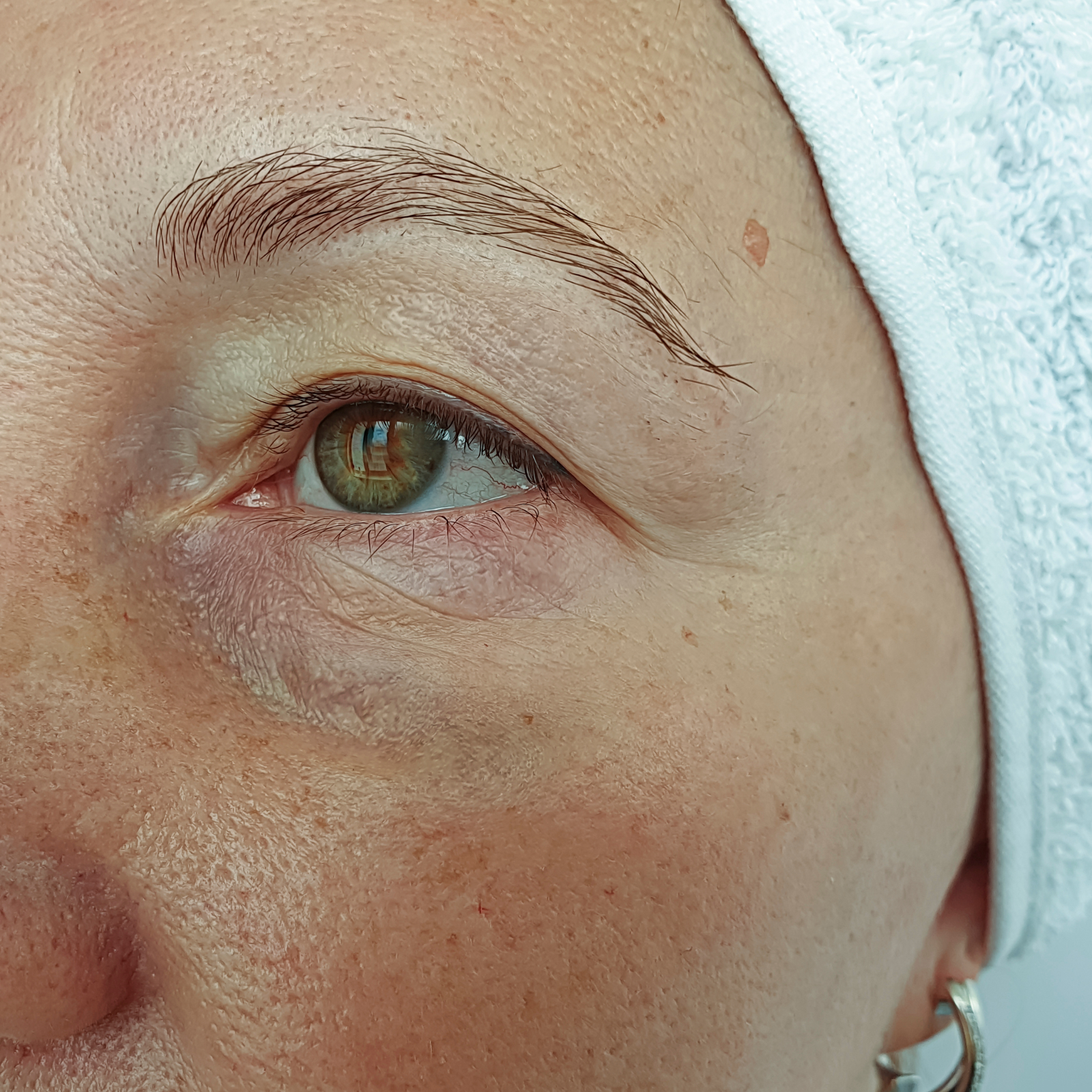 Injections de Botox à Casablanca Injections de Botox à Casablanca