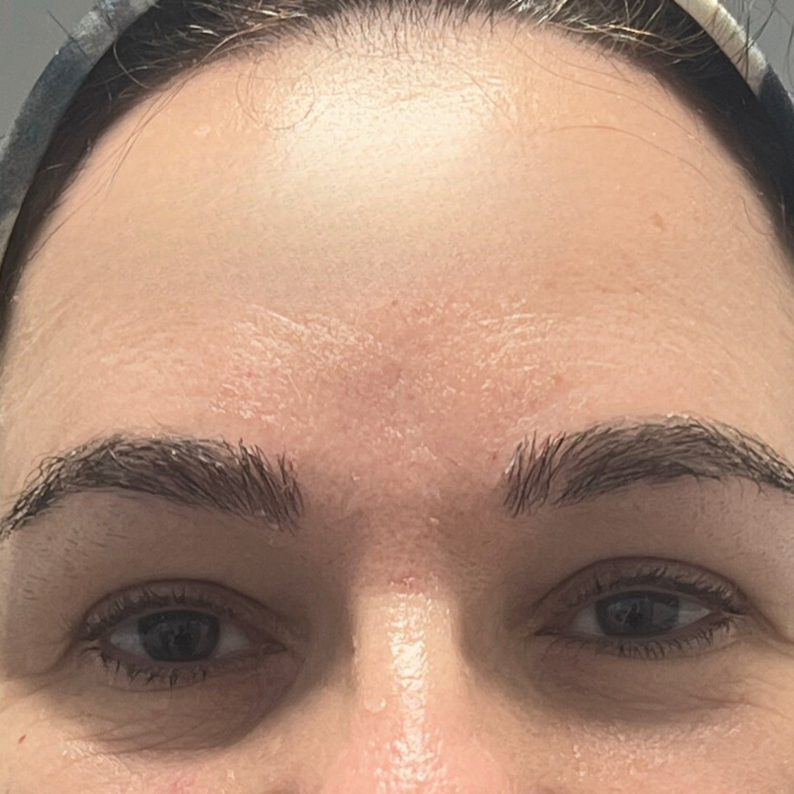 Injections de Botox à Casablanca Injections de Botox à Casablanca