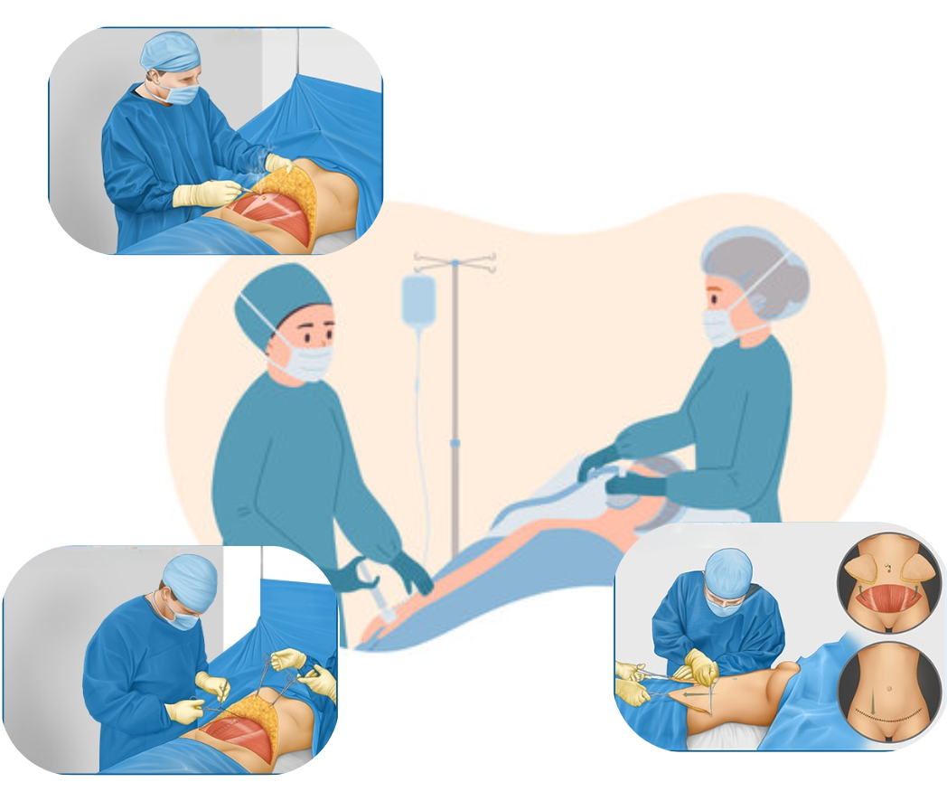 hc aesthetics-cabinet-Abdominoplastie chirurgy hc aesthetics-cabinet-Abdominoplastie chirurgy