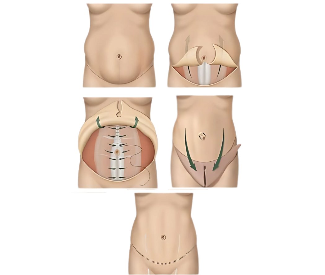 hc aesthetics-cabinet-Abdominoplastie