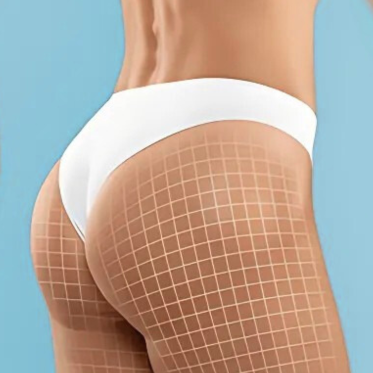 BBL à Casablanca : Redessinez Vos Fesses avec Sécurité et Technologie Avancée HC Aesthetics hc aesthetics-cabinet-BBL Avant apres