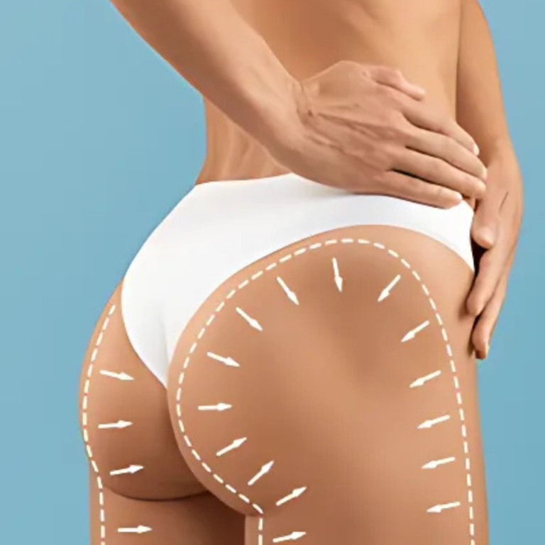 BBL à Casablanca : Redessinez Vos Fesses avec Sécurité et Technologie Avancée HC Aesthetics hc aesthetics-cabinet-BBL Avant apres