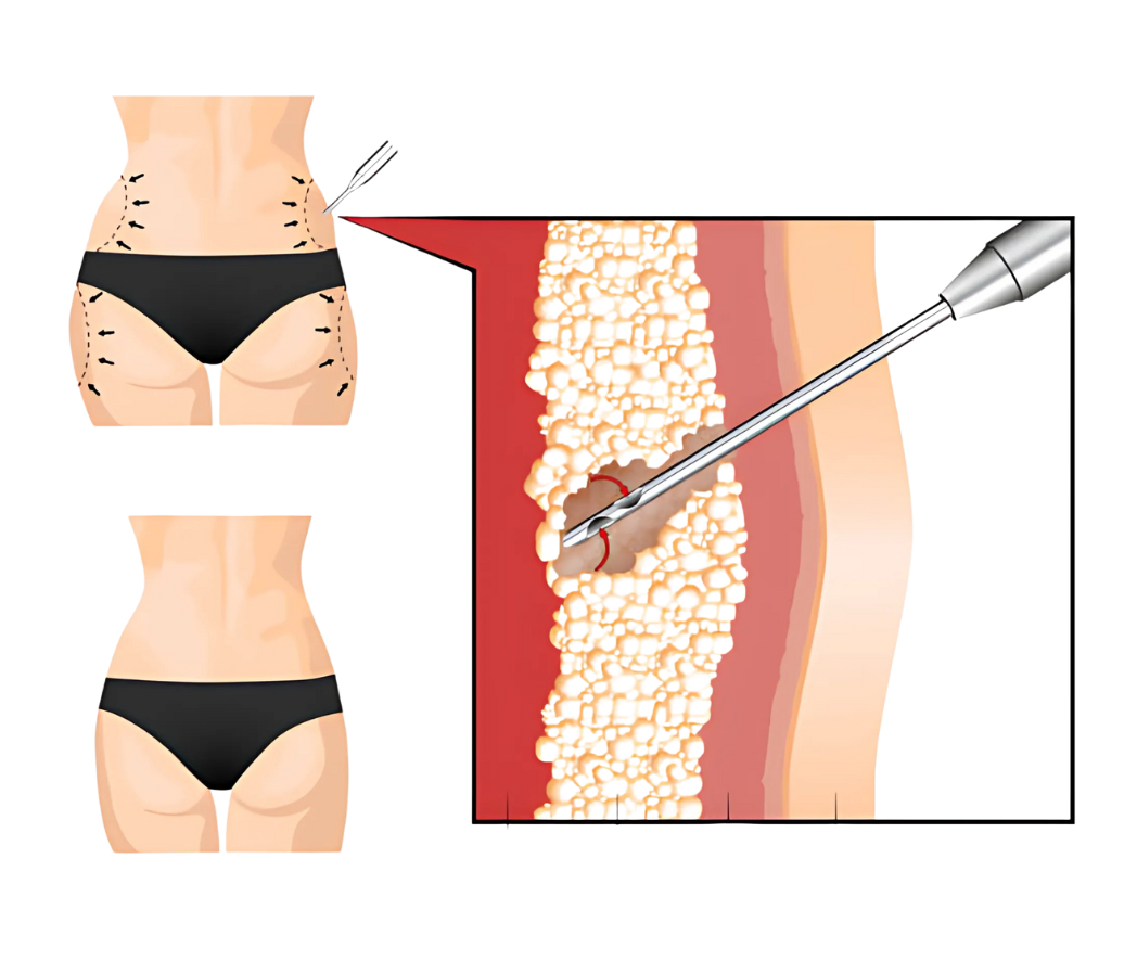 hc aesthetics-cabinet-Liposussion