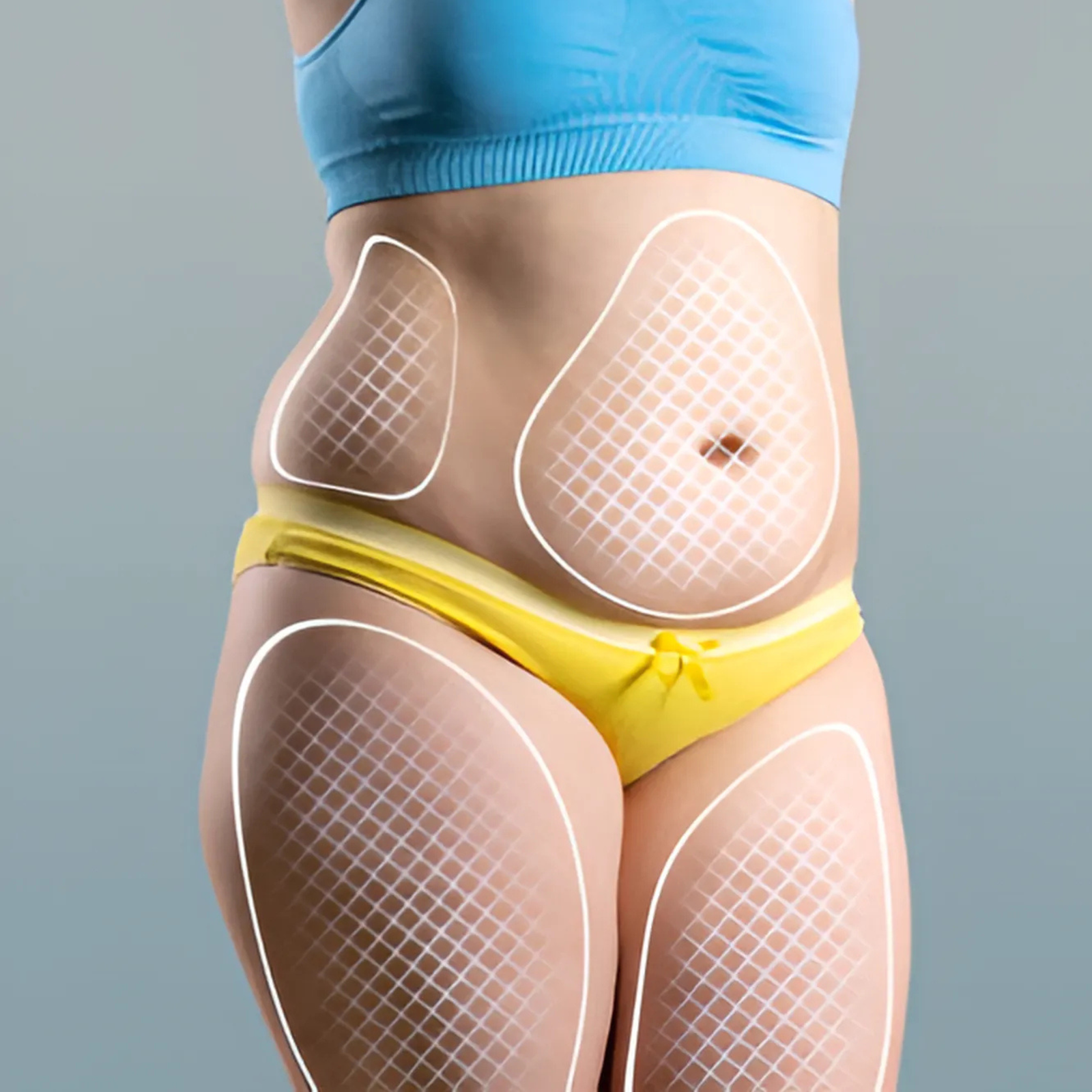 hc aesthetics-cabinet-Liposussion Avant Apres hc aesthetics-cabinet-Liposussion Avant Apres