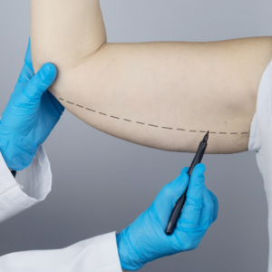 hc aesthetics-cabinet-lifting des bras