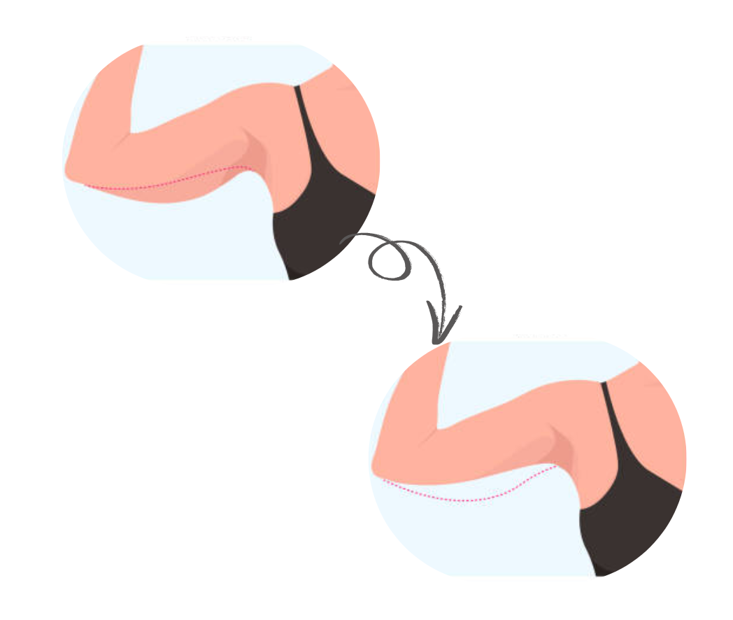 hc aesthetics-cabinet-lifting des bras
