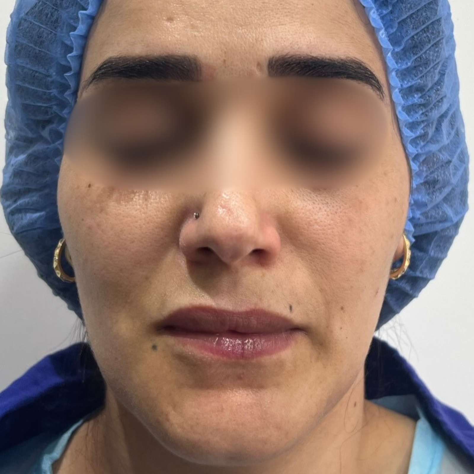 hc aesthetics-cabinet-lipofiling avant apres hc aesthetics-cabinet-lipofiling