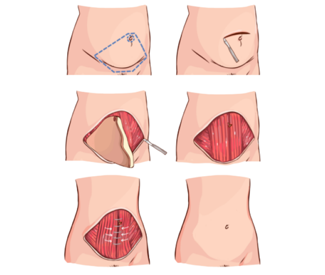 hc aesthetics-cabinet-mommy makeover
