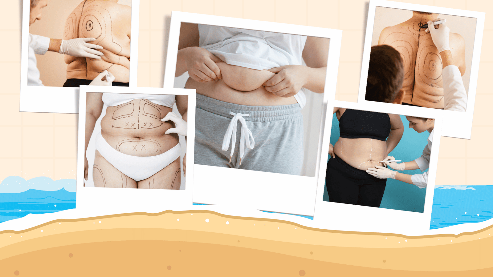 Liposuccion en été