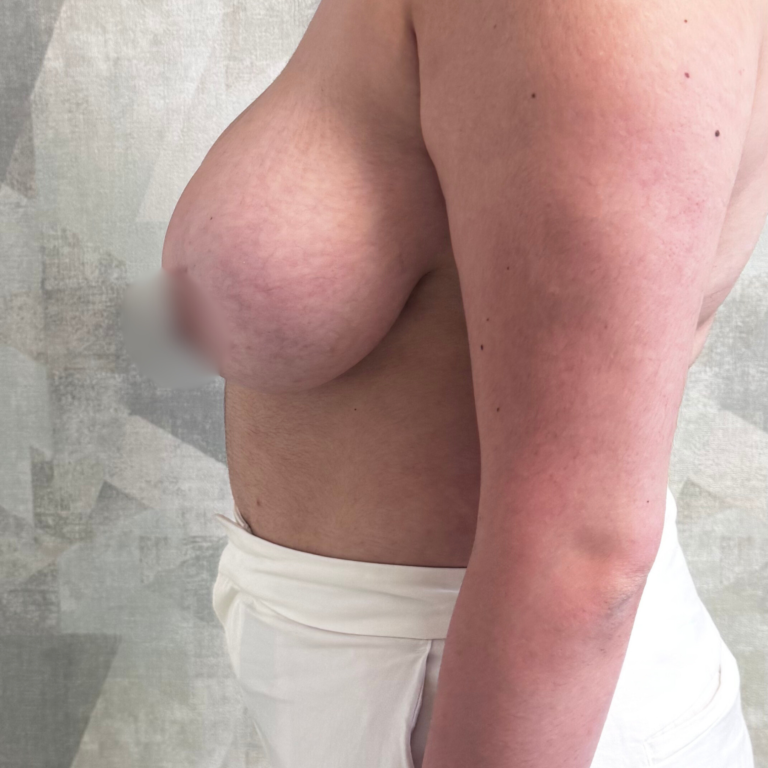 Réduction mammaire à Casablanca : esthétique et confort retrouvés HC Aesthetics chebaak- reduction mammaire intevention