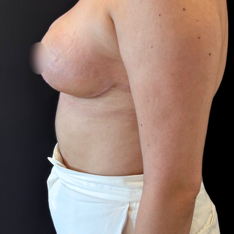 Réduction mammaire à Casablanca : esthétique et confort retrouvés HC Aesthetics chebaak- reduction mammaire intevention