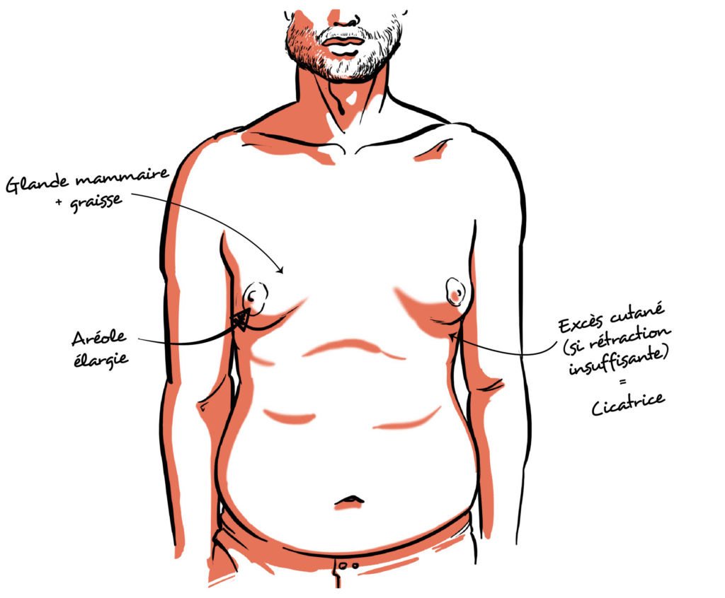 Chirurgie de la gynécomastie