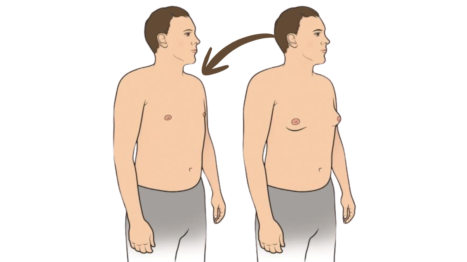Gynecomastie