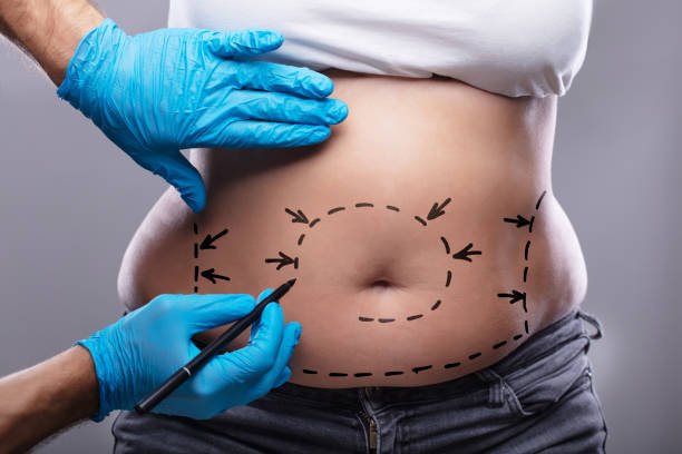 Lipo-abdominoplastie