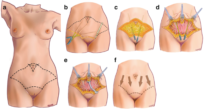 Lipo-abdominoplastie