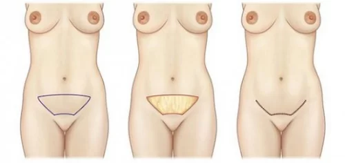Mini-abdominoplastie : la solution parfaite pour un petit relâchement du bas-ventre