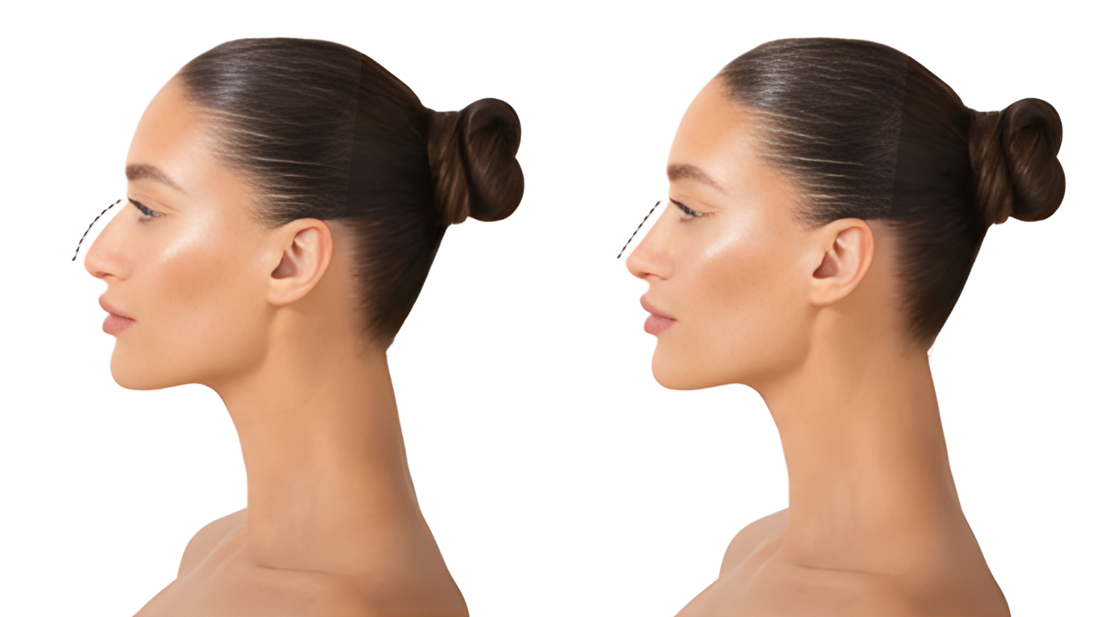 Pourquoi choisir la rhinoplastie ultrasonique à Casablanca