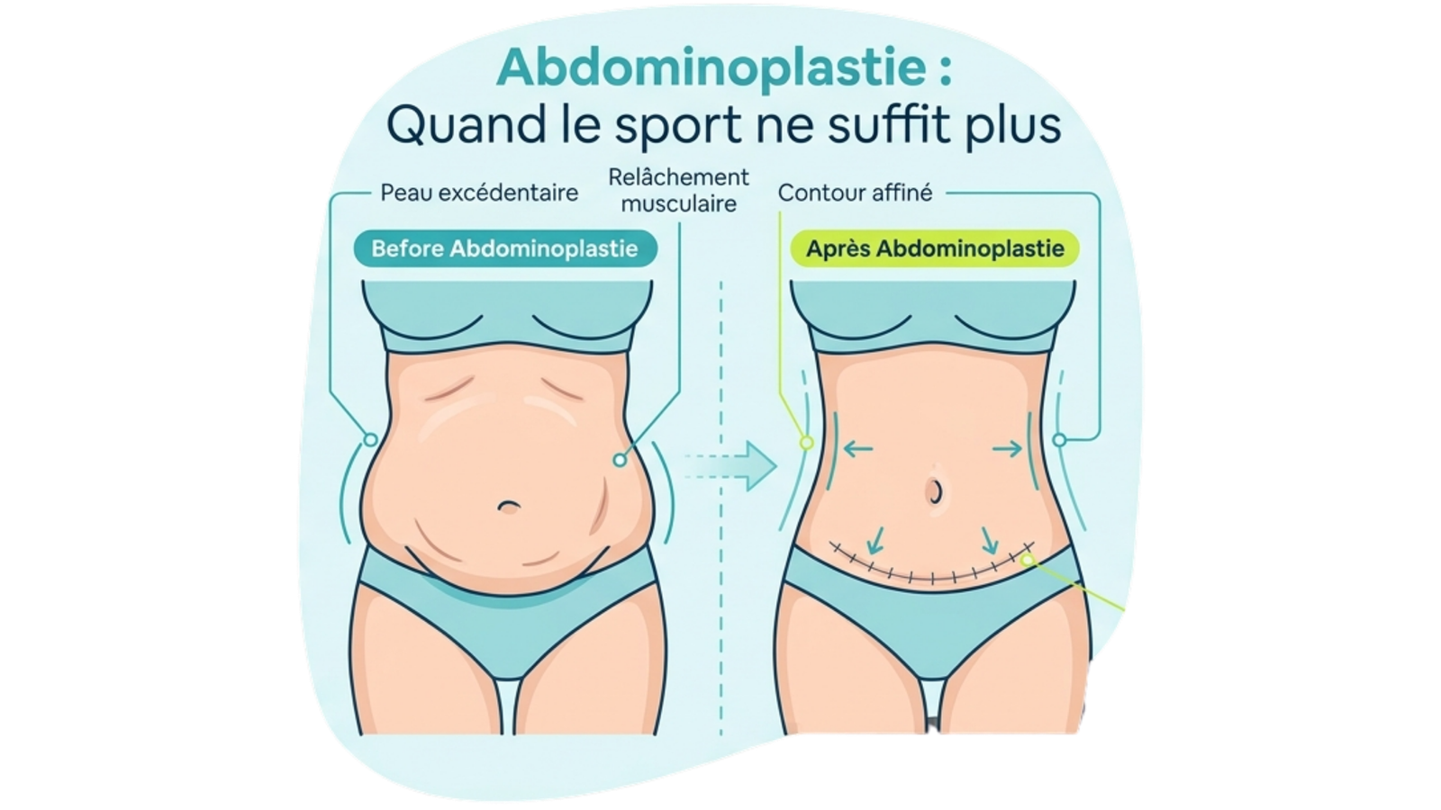 Abdominoplastie à Casablanca : quand le sport ne suffit plus