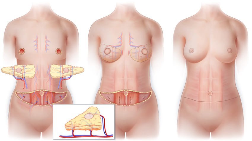 Après un Cancer du Sein : Comment Retrouver une Harmonie entre les Deux Seins ?