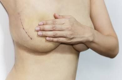 Chirurgie mammaire après cancer : quels facteurs déterminent le bon moment pour intervenir ?