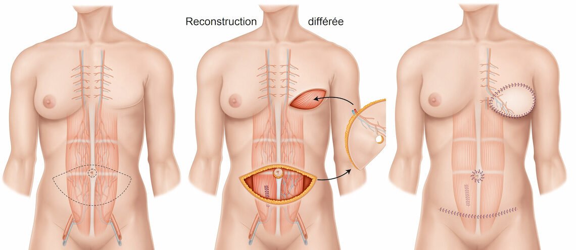 Reconstruction mammaire après mastectomie : quelles options sont possibles ?